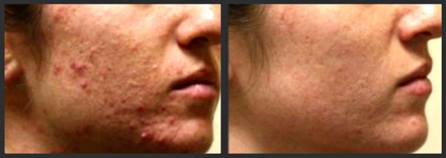 Fraxel Acne Scarring Treatment