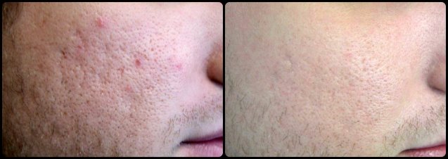Fraxel Acne Scarring Treatment
