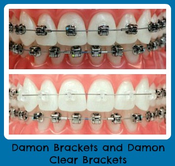Damon Braces DentaDerm Clinic