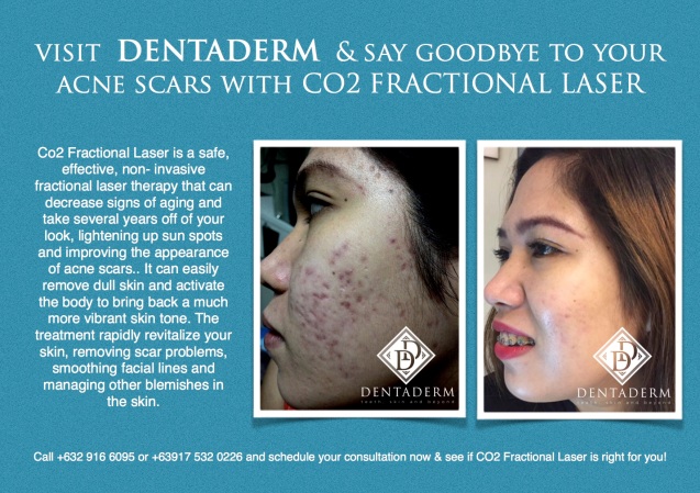 Visit DENTADERM  & say goodbye to your acne scars with CO2 FRACTIONAL LASER